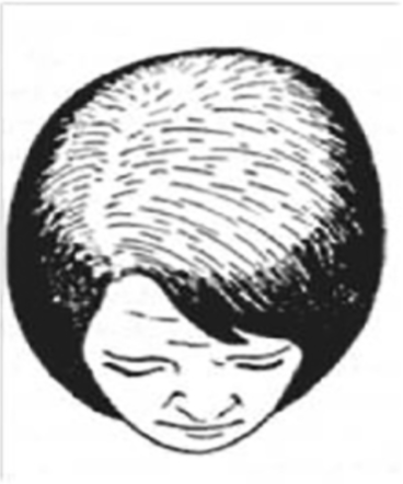 Ludwig Stage II female pattern hair loss — moderate crown and vertex thinning, scalp increasingly visible from above