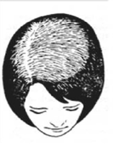 Ludwig Stage I female pattern hair loss — early central parting widening with minimal crown thinning, frontal hairline fully intact