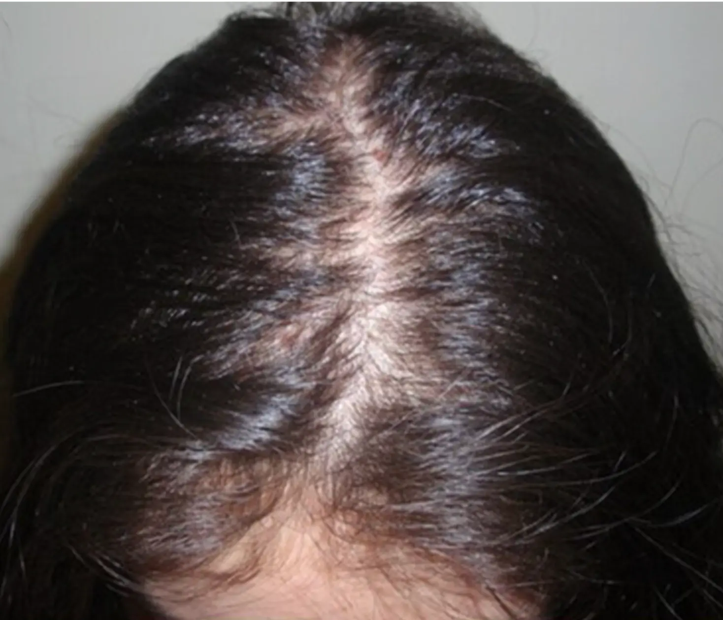 Diffuse Patterned Alopecia (DPA) — hair loss confined to the top of the scalp with temporal, parietal and occipital donor zones intact, potentially suitable for hair transplant candidacy