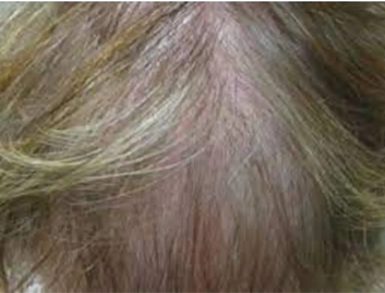 Diffuse Unpatterned Alopecia (DUPA) — miniaturisation extending into the donor zones at the back and sides of the scalp, contraindication for hair transplant surgery