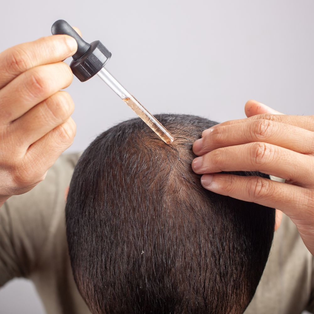 Minoxidil for Hair Loss: Does It Work? A Specialist’s Honest Guide