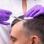 Clinician injecting PRP into a patient scalp for hair loss treatment